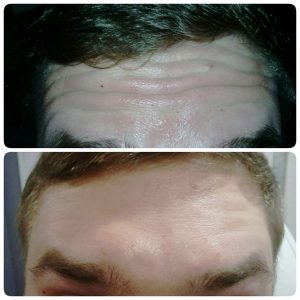 уколы ботокса